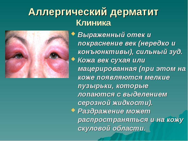 Дерматит век: причины воспаления кожи вокруг глаз, методы лечения болезни у детей и взрослых