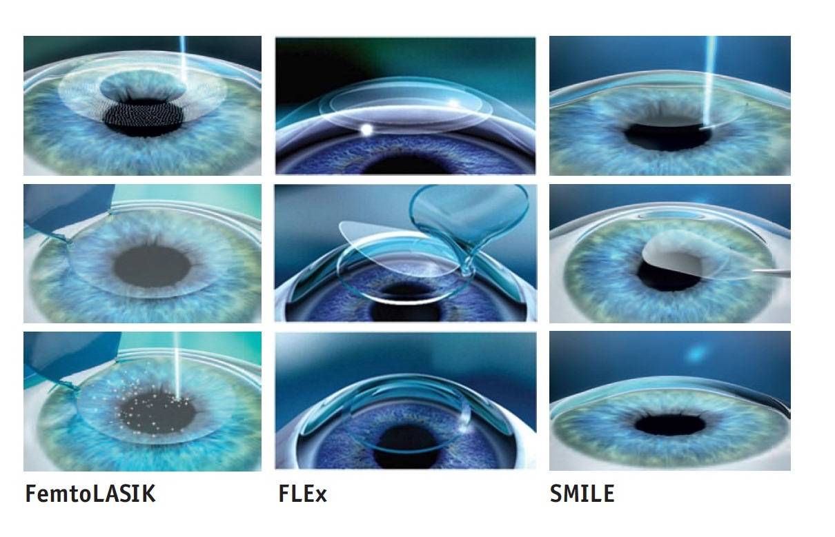Фрк - операция на глаза: что это за метод, как проходит операция и восстановительный период, отзывы пациентов