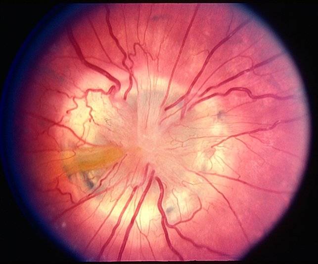Колобома сосудистой оболочки глаза: причины, симптомы и лечение