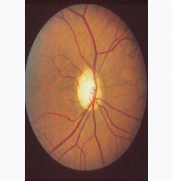 Колобома глаза (века, хрусталика, диска зрительного нерва, сосудистой оболочки, хориодеи, сетчатки): причины, симптомы, лечение, врожденная и приобретенная формы