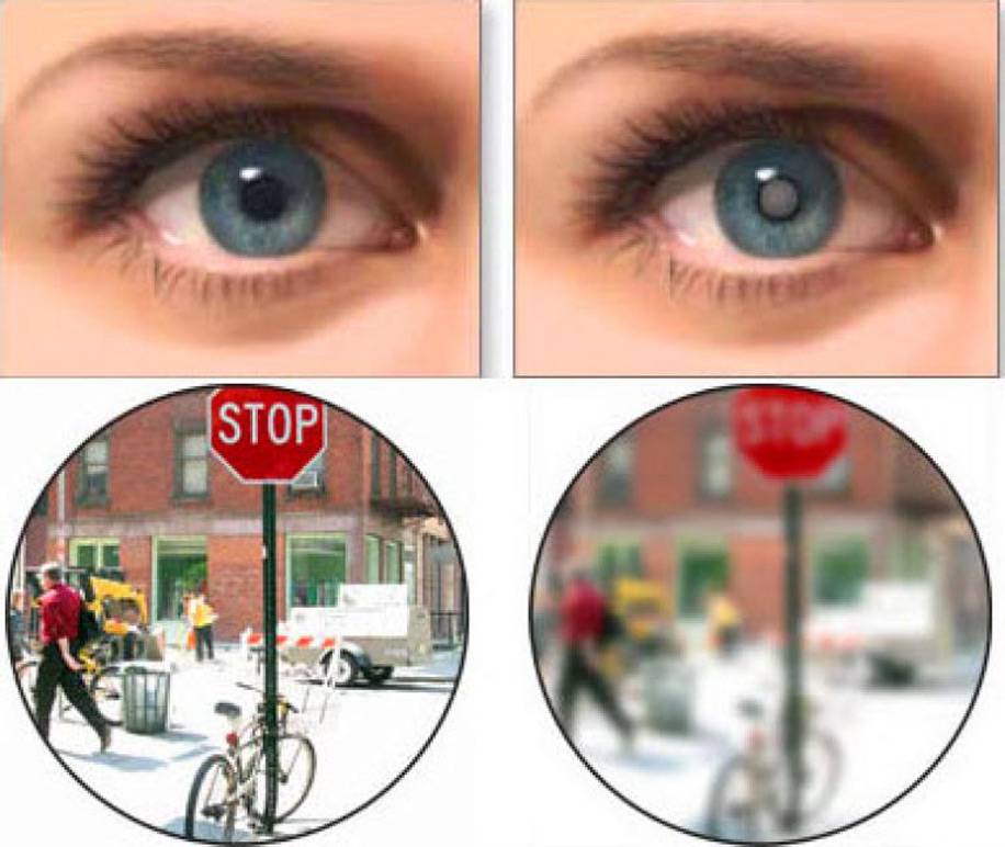 Зрение минус 1: причины и методы лечения - "здоровое око"