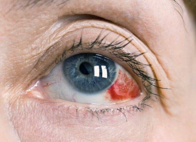Из-за чего бывают голубыми белки глаз? симптомы, диагностика и лечение