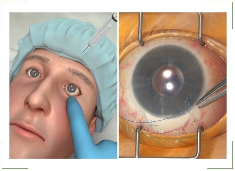 Операция при глаукоме: способы проведения и реабилитация