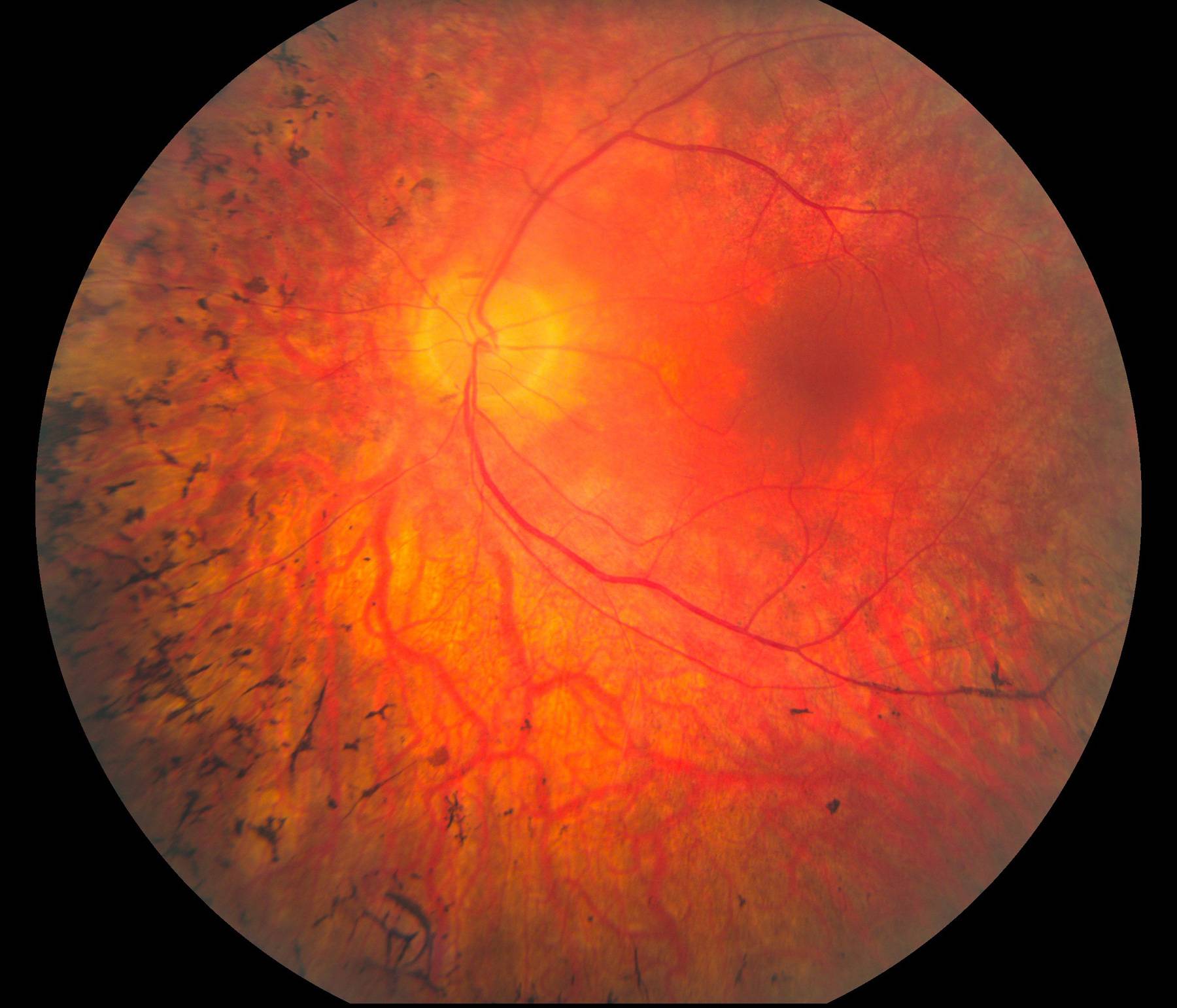 Ретинит - воспаление сетчатки глаза, лечение, причины, симптомы
