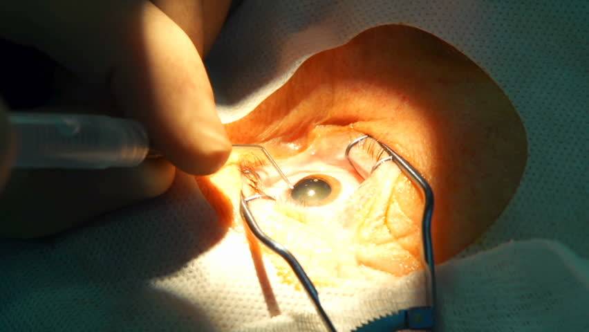 Склеропластика глаз: суть, показания, виды операции, ход, реабилитация