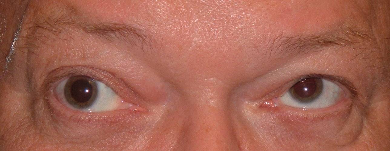 Аккомодация глаза: виды нарушений и методы лечения