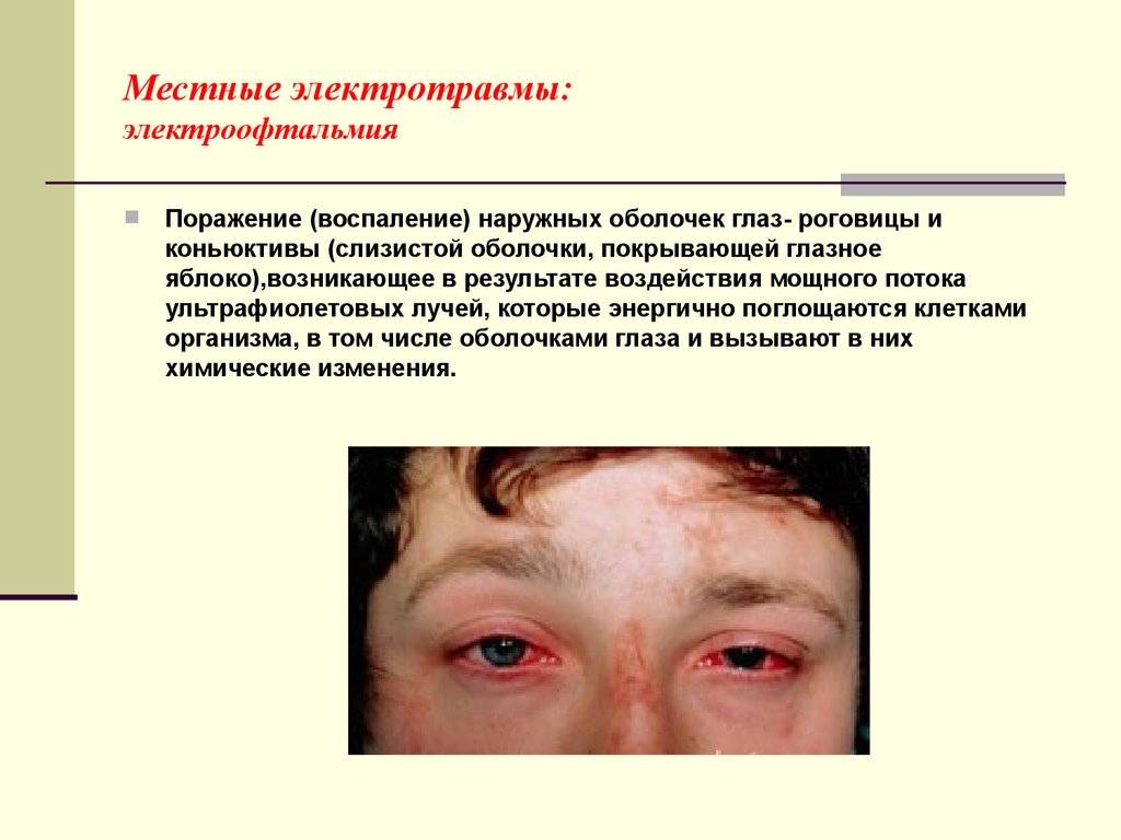 Офтальмогипертензия глаз: что это, лечение, симптомы, причины, осложнения и профилактика