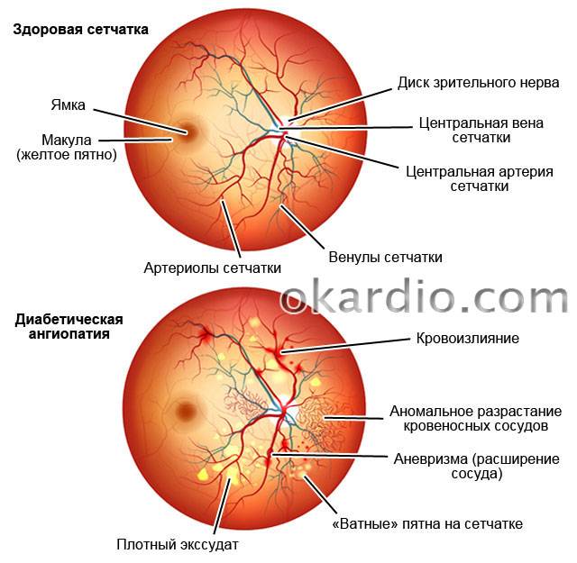 Ангиопатия (вазопатия, ангионевроз) сосудов сетчатки глаза