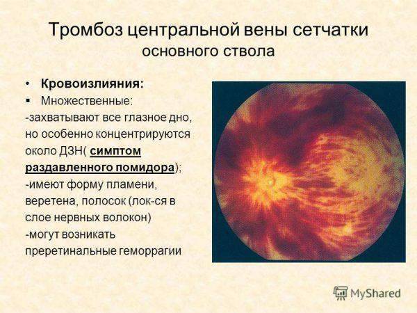 Тромбоз центральной вены сетчатки глаза: лечение, что это такое, цвс,