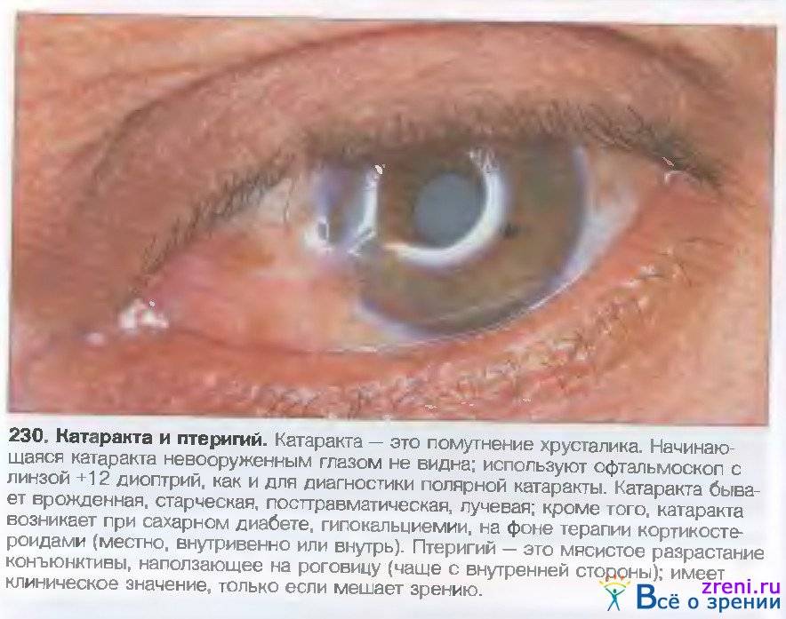 Заболевания глаз (глазные болезни) | все болезни глаз