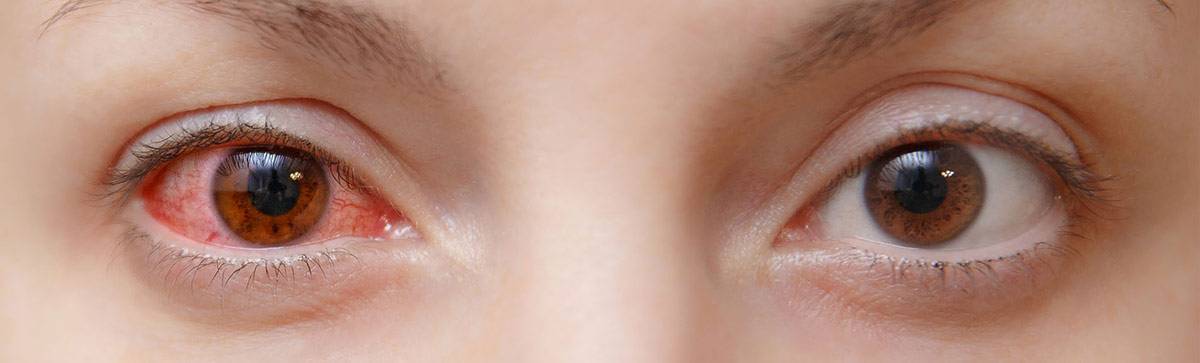 Кератоконъюнктивит: симптомы, причины, лечение - "здоровое око"