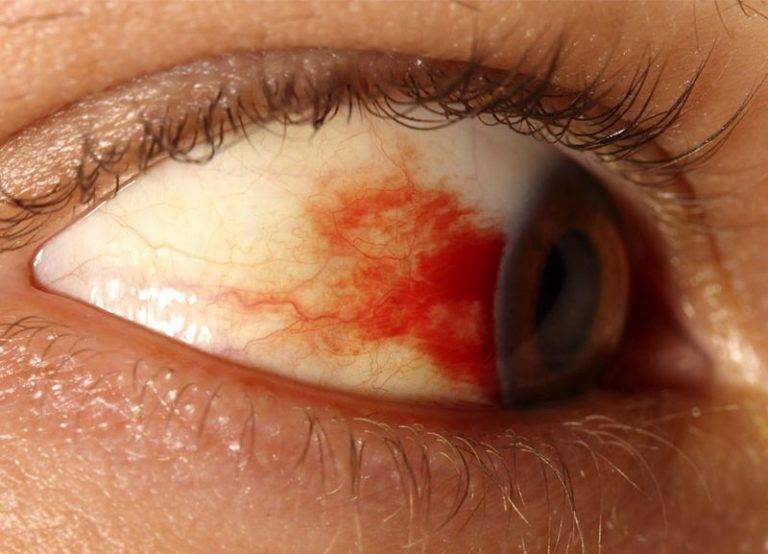 Внезапное кровоизлияние в стекловидное тело глаза: лечение