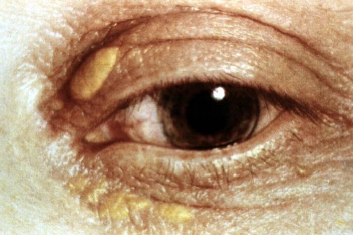 Желтые пятна на веках глаз: причины появления