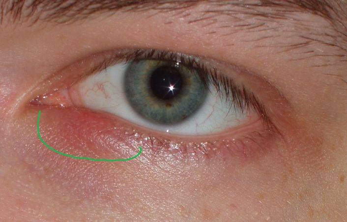 Болит глаз под верхним веком: причины, симптомы, лечение