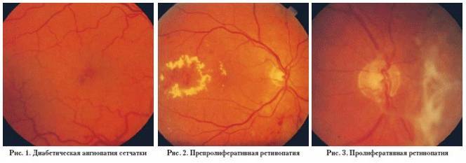 Ангиопатия сетчатки глаза: причины, симптомы и лечение ангиопатии сосудов сетчатки - medside.ru