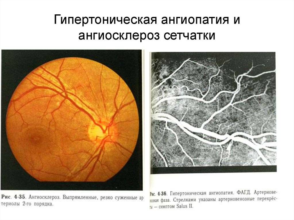 Ангиопатия сетчатки глаза - симптомы, причины и лечение