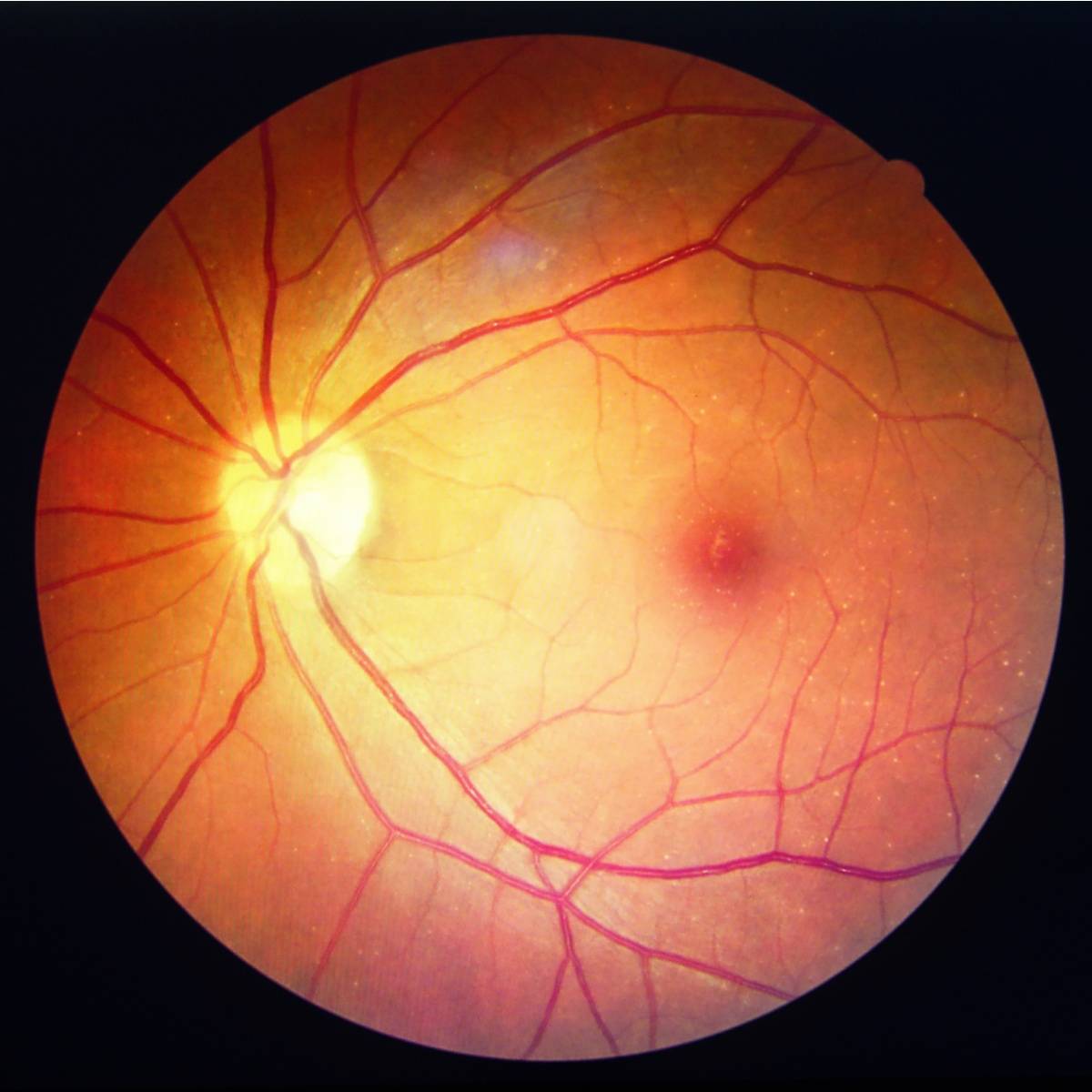 Диабетическая ретинопатия: медикаментозное лечение пролиферативной, непролиферативной ретинопатии каплями, уколами, препаратами, народными средствами, операцией, лазером