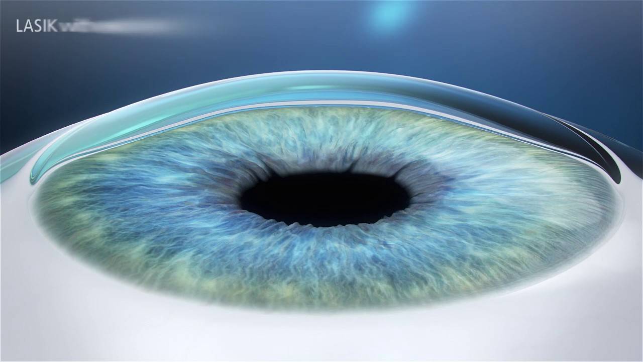 Фемто ласик (femto lasik) лазерная коррекция зрения - описание операции, последствия