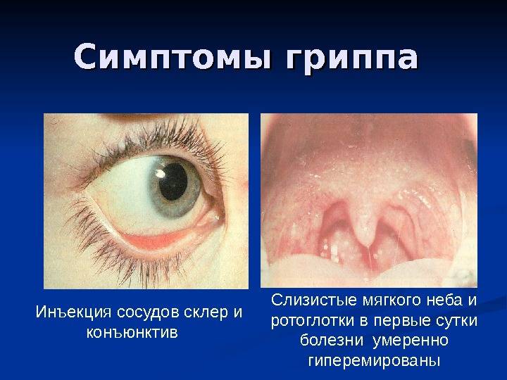 Эписклерит глаза: причины, симптомы, диагностика и лечение