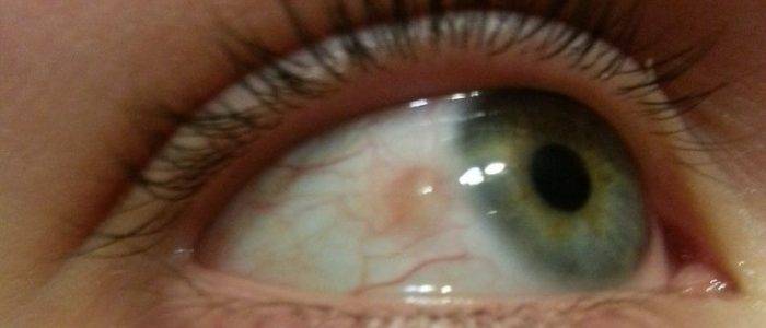 Пингвекула глаза: что это такое, причины и лечение