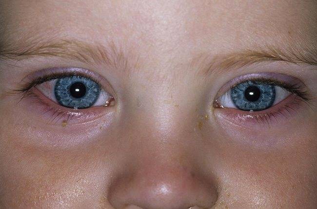 Комаровский - конъюнктивит: лечение глаз у детей, что делать если гноится глазик у новорожденного