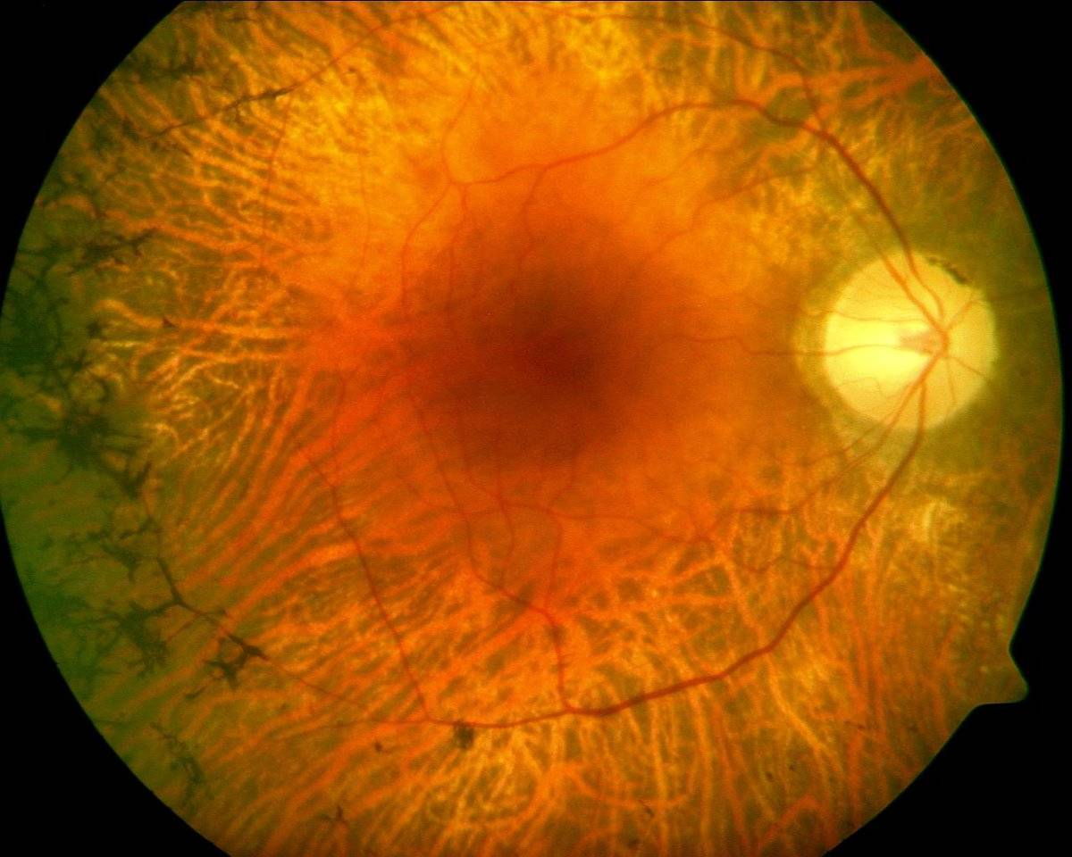 Отслоение сетчатки глаза: причины, симптомы, лечение и профилактика