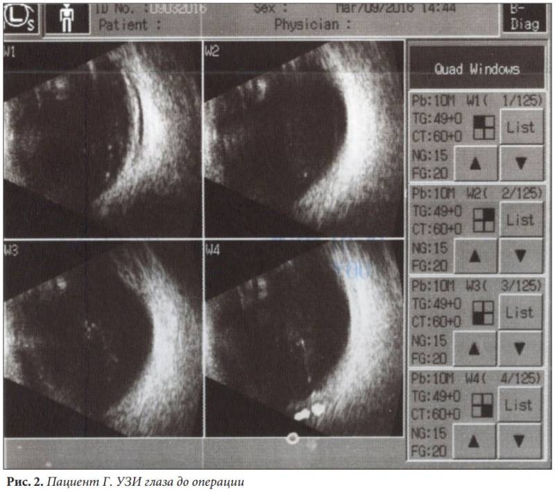 Кт глазных орбит - что показывает, показания и противопоказания к компьютерной томографии орбит глаз