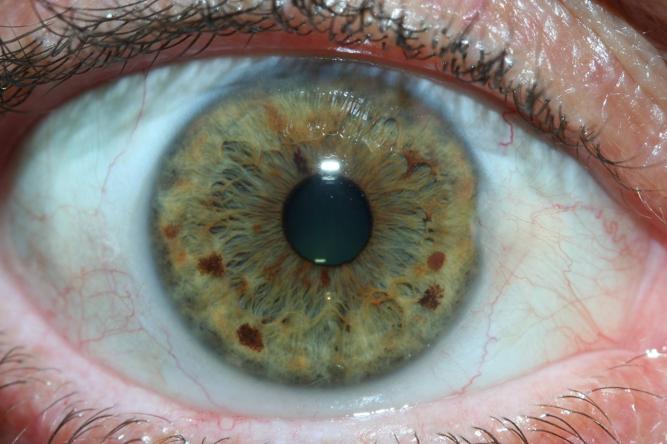 Что означает черная точка на радужке глаза. иридодиагностика
