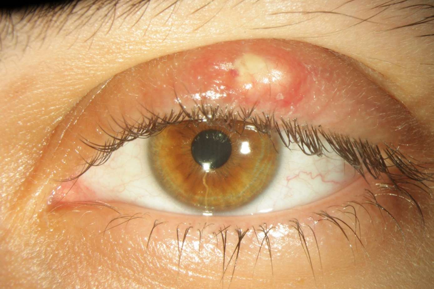 Ячмень на глазу: фото, начальная стадия, первые признаки начала заражения, начинающие воспаление симптомы, как начинается лечение