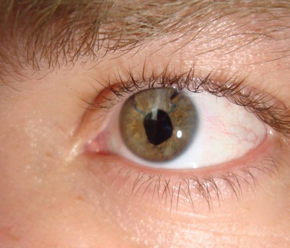 Склерит глаза: виды, причины, симптомы, лечение и осложнения
