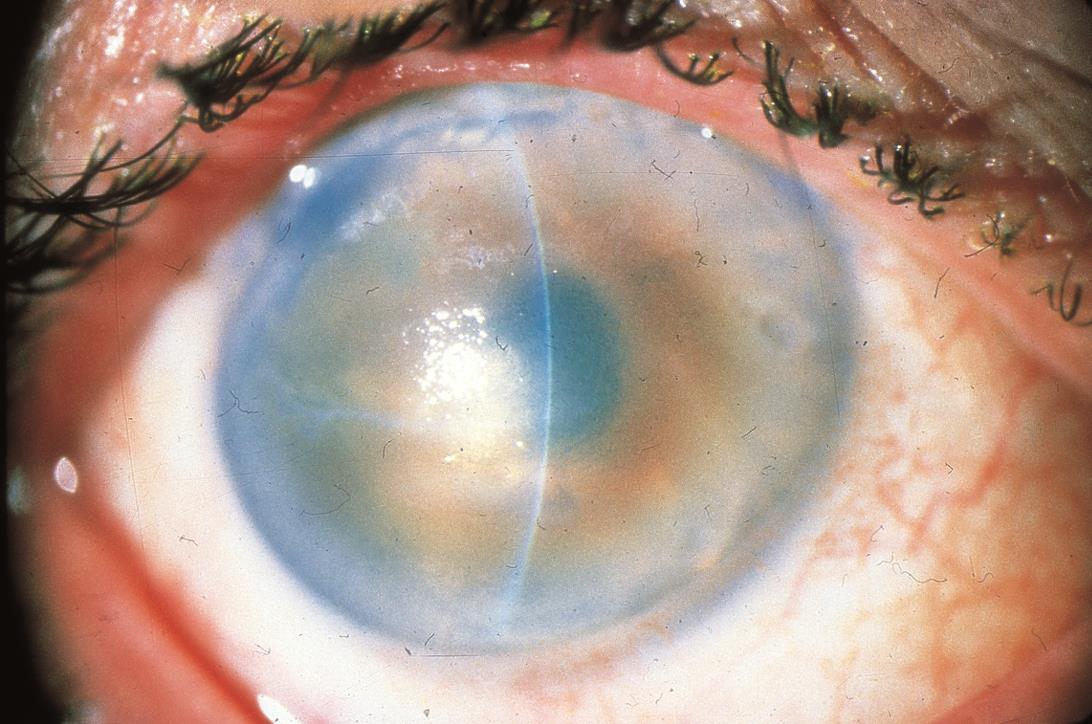Повреждение роговицы глаза - причины, симптомы и лечение