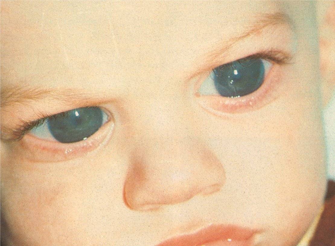 Как выглядит колобома глаза – виды, причины и лечение дефекта