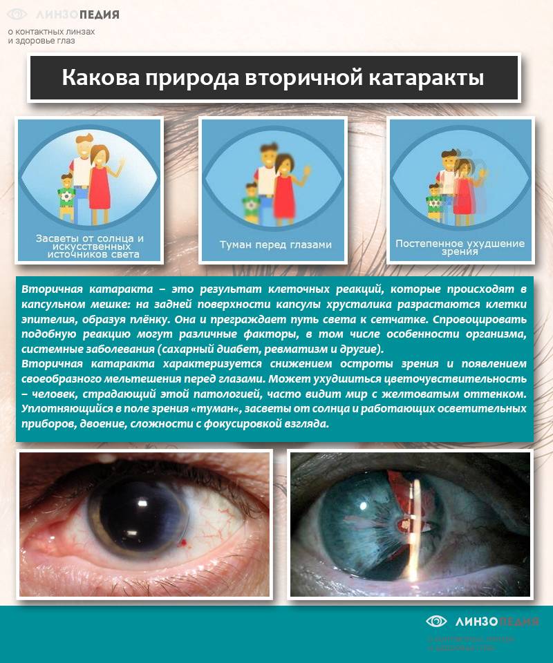 Астигматизм после замены хрусталика глаза при катаракте: осложнения после операции — глаза эксперт