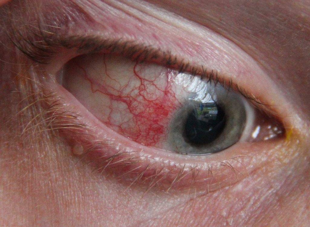 Причины склерита глаза у детей и взрослых — виды склерита и симптомы заболевания