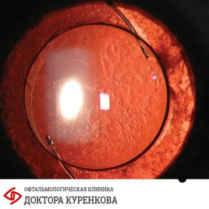 Фиброз стекловидного тела (сетчатки) глаза
