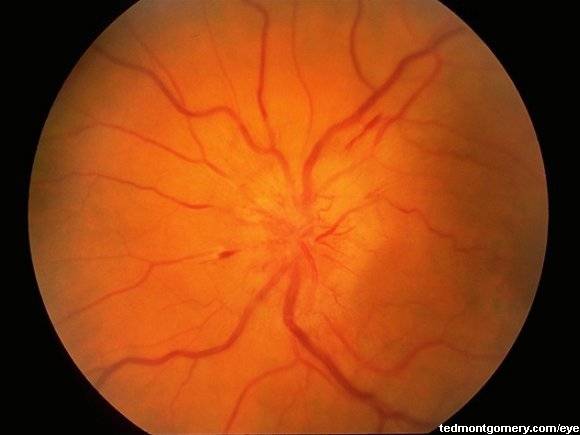 Ишемическая нейропатия зрительного нерва. причины, симптомы, лечение