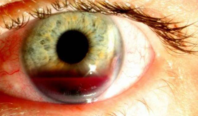 Гифема глаза: лечение кровоизлияния в переднюю камеру, симптомы