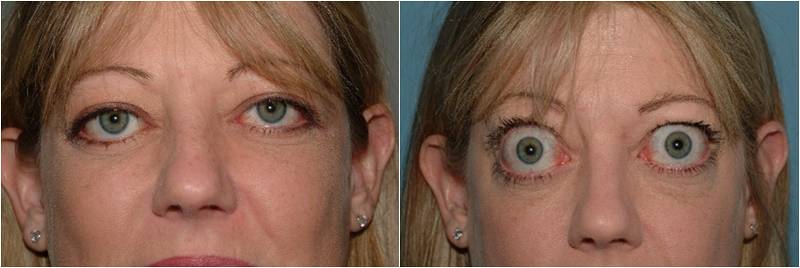 Экзофтальм – болезнь выпученных глаз