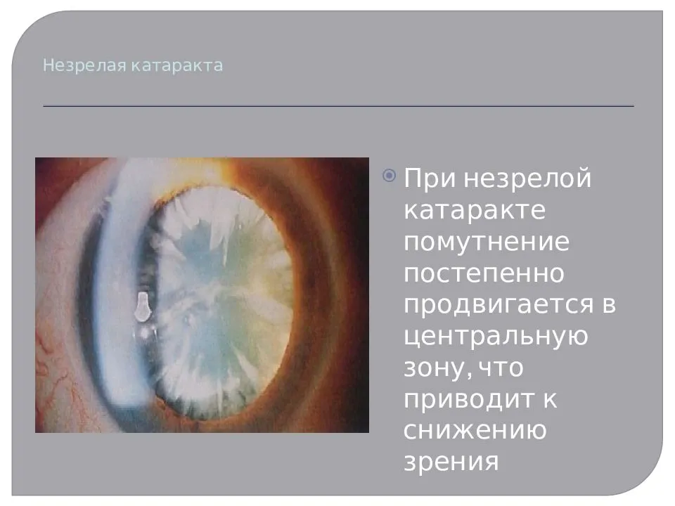 Незрелая катаракта: симптомы, лечение и нужна ли операция