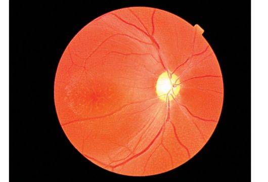 Ретиношизис сетчатки глаза: причины, диагностика и лечение | malyshlandia.ru
