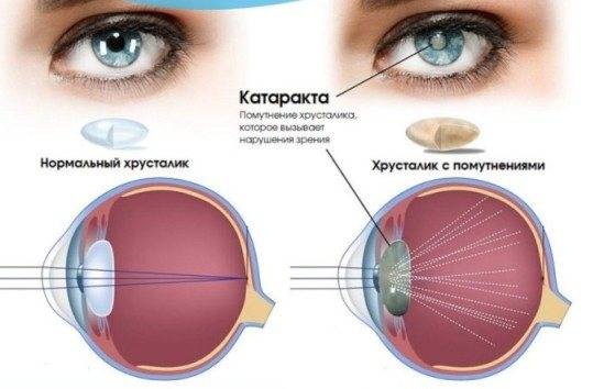 Причины и лечение головокружения и раздвоения в глазах