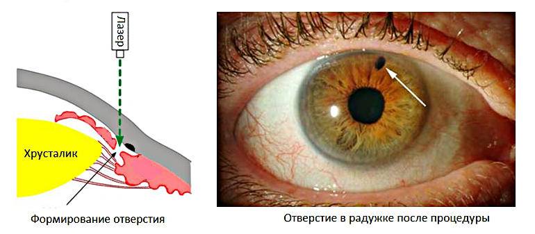 Что такое эпиретинальная мембрана глаза и чем она опасна для зрения