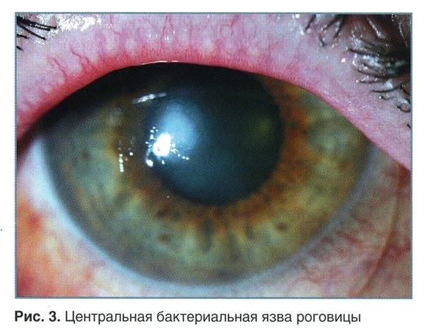 Язва роговицы глаза у человека: лечение