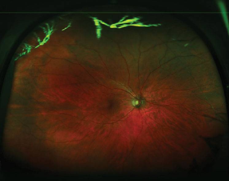 Витреолизис - лазерное удаление мушек в глазах, отзывы, последствия, цена