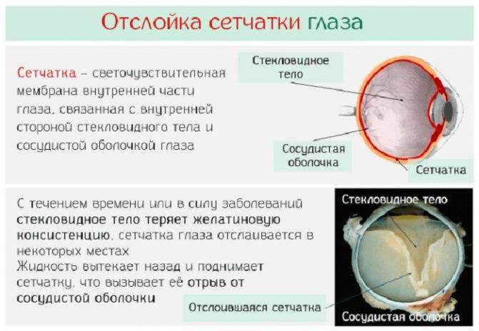 Отслойка стекловидного тела | мнтк «микрохирургия глаза» им. акад. с.н. федорова