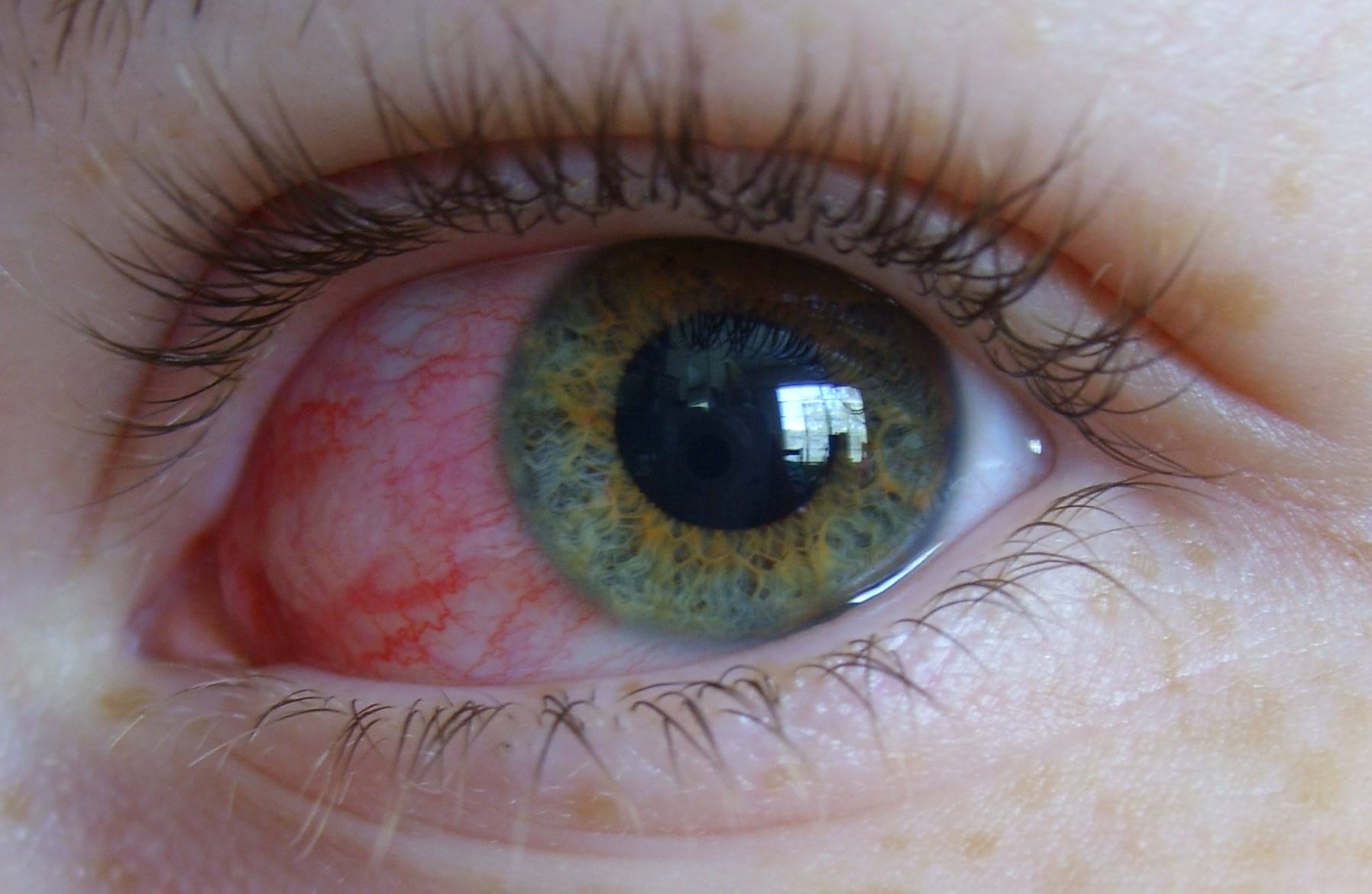 Царапина на роговице глаза, первая помощь и лечение - "здоровое око"