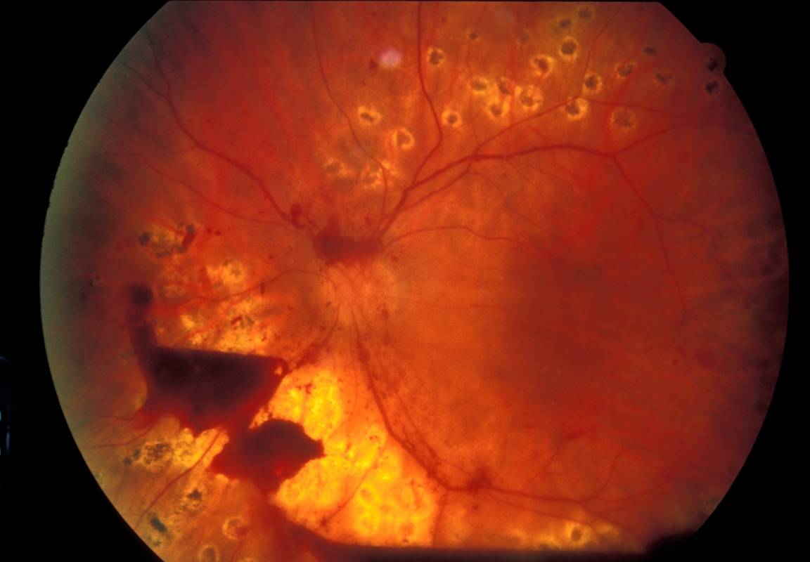 Кровоизлияние в глаз: причины и лечение, какие капли капать, диагностика, локализация (в склере, сетчатке, белке, передней камере), фото, профилактика
