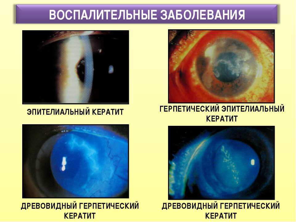 Нитчатый кератит глаза - симптомы и лечение патологии