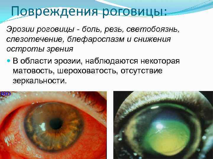 Особенности образования и лечения эрозии роговицы глаза
