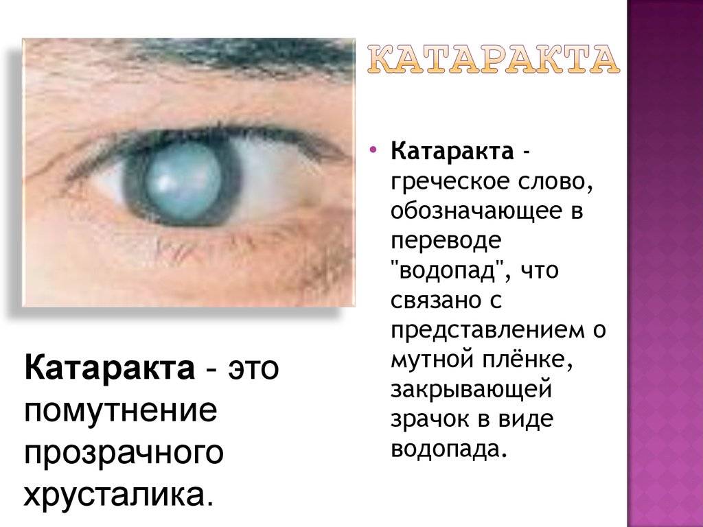 Как начинается катаракта глаза – основные симптомы
